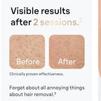 ✨ IPL Laser Hair Removal Device – Unisex | 999,999 Flashes | Rechargeable & Painless